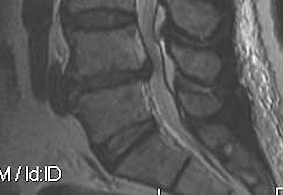 Lumbar Disc Extrusion